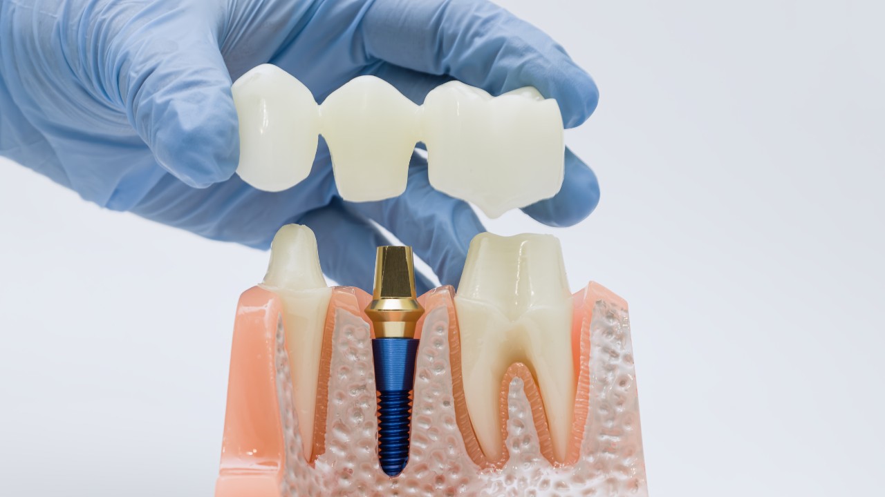 High-Intent vs. Research Keywords: dental implants near me